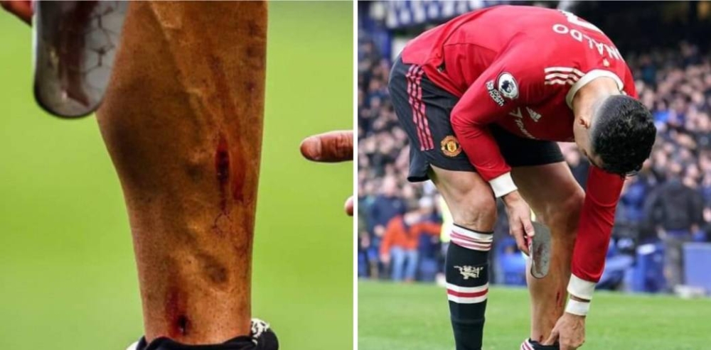 شاهد.. جرح عميق في قدم رونالدو أثناء مباراة مانشستر يونايتد وايفرتون !